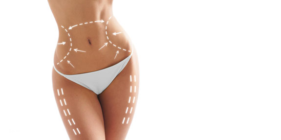 Liposuktion Hoexter